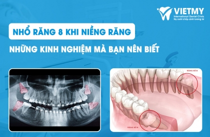 Niềng Răng Nhổ Răng Số 8: Vị Trí, Tình Trạng và Cách Thực Hiện An Toàn